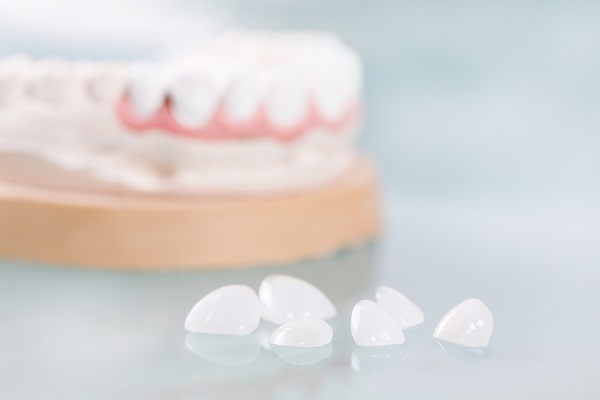 When Are Dental Veneers Recommended?