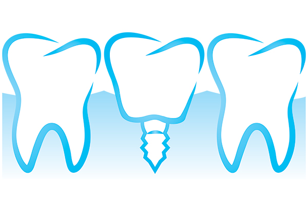 Get An Immediate Implant Tooth To Replace Your Diseased Tooth