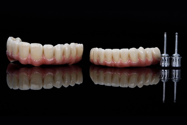 The Longevity Of Implant Supported Dentures