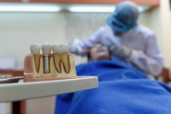 Can My Dentist Place Multiple Implants In One Appointment?